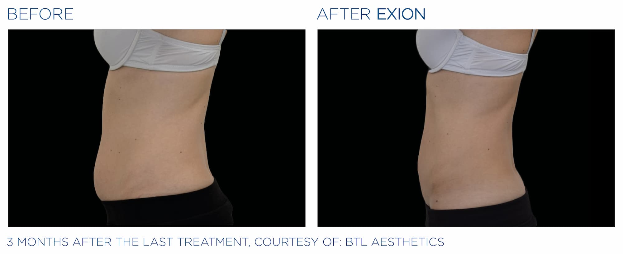 a womans abdomen before and after an Exion medical aesthetics treatment