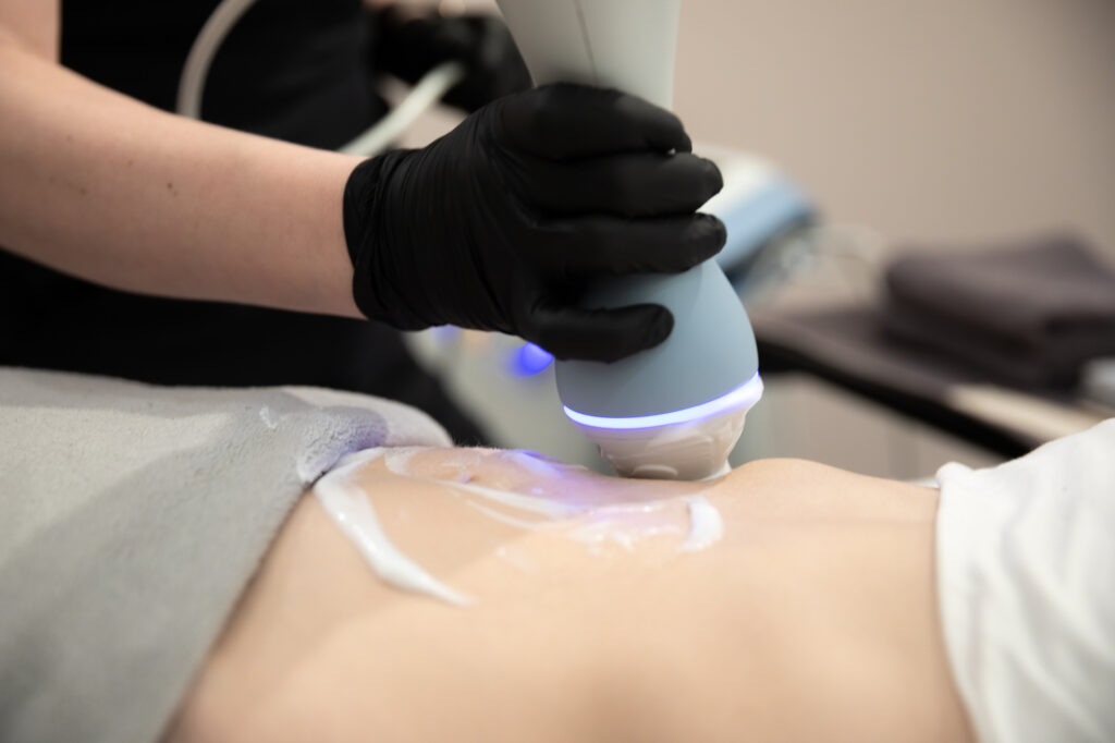 Emtone, a device for body sculpting in Denver, treating a patients abdomen