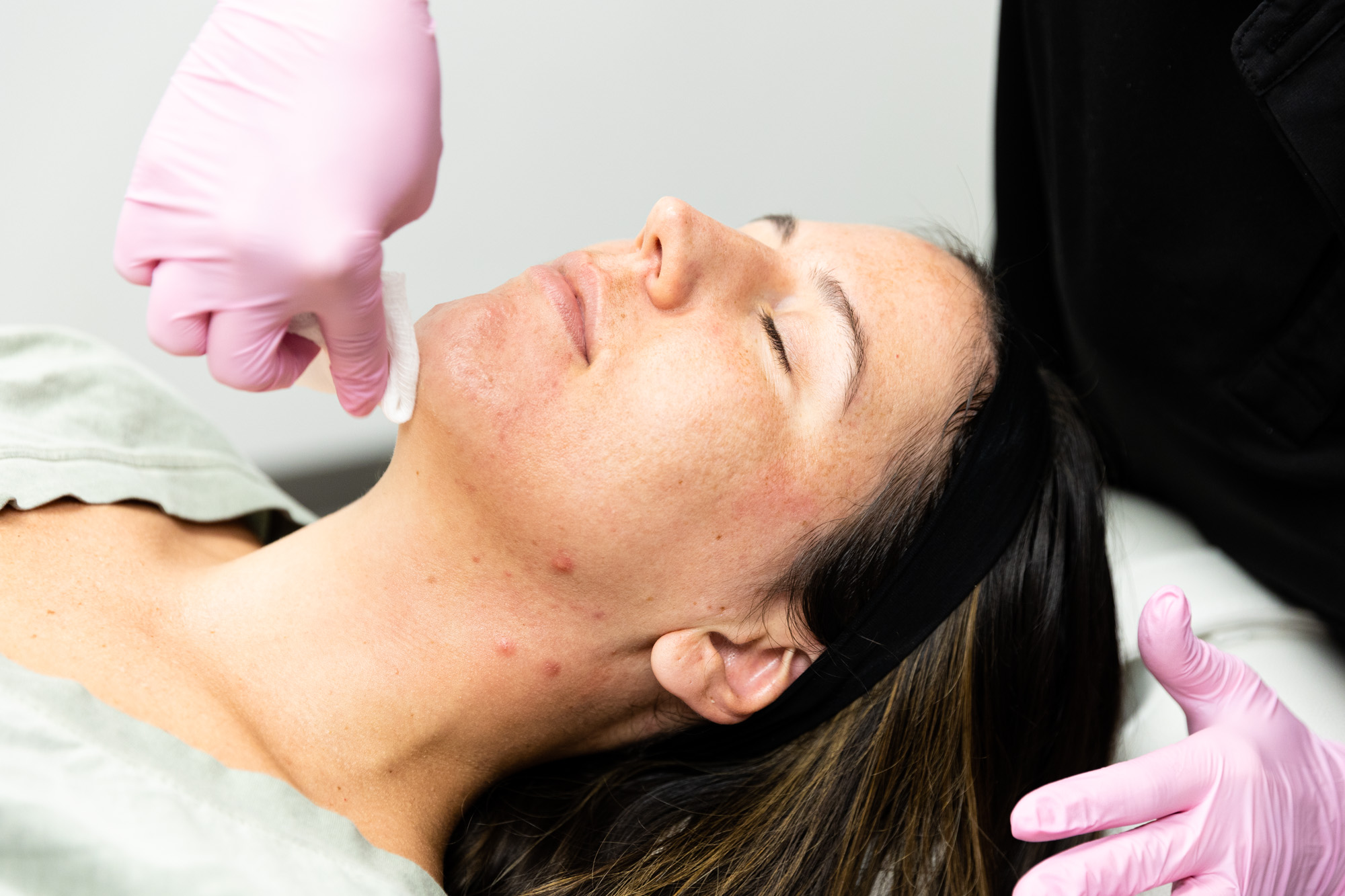 A woman getting a microneedling treatment in Denver at The Longevity Lab