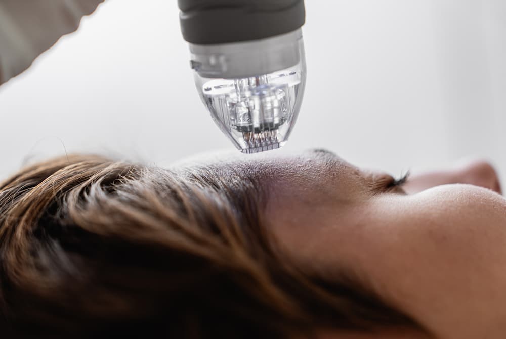 A close up of microneedling in Denver